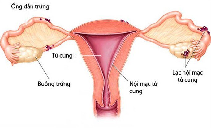 Lạc nội mạc tử cung là nguyên nhân gây đau lưng kinh nguyệt thường gặp.jpg